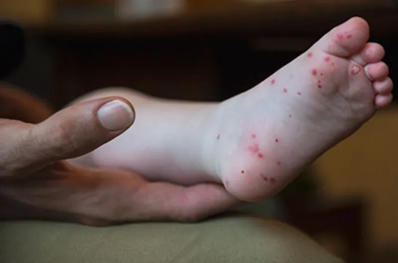 Brote viral en Fairfax: cómo proteger a los peques del mano-pie-boca