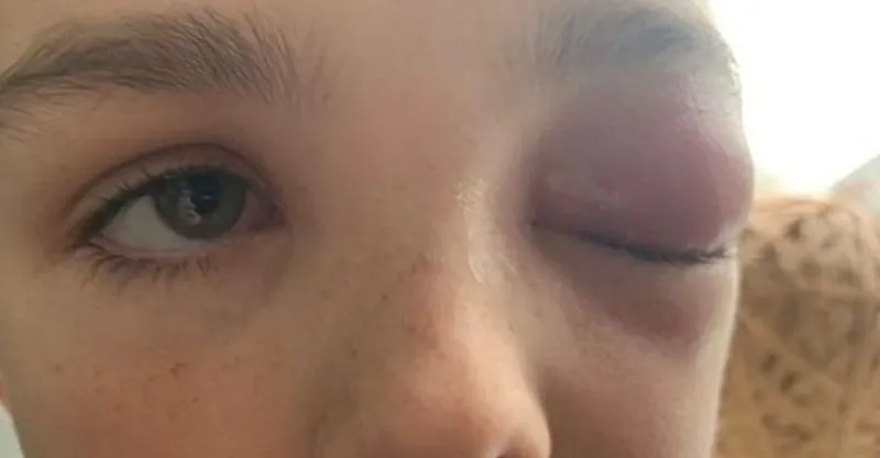 Niño británico casi queda ciego como secuela del COVID-19