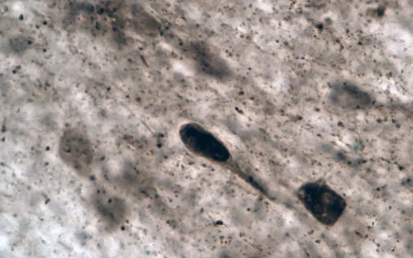 ¿Cómo afecta esta bacteria al Parkinson?