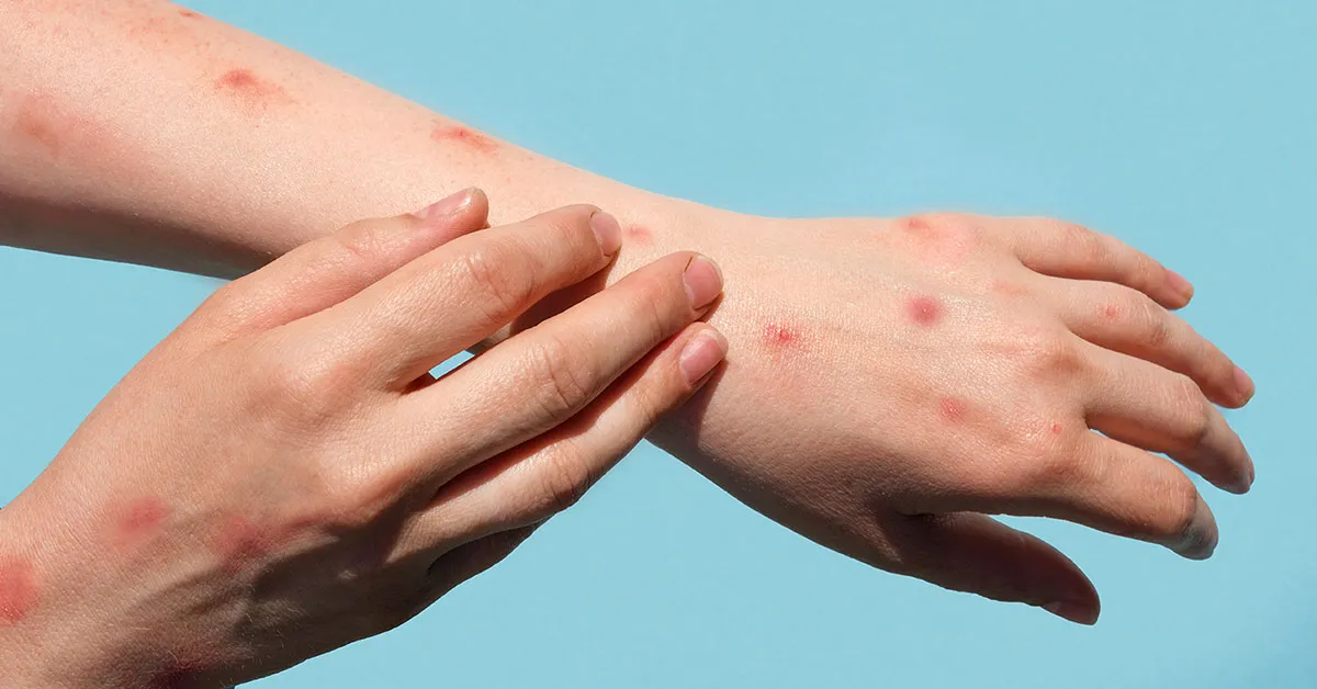 Virginia se enfrenta actualmente a un reto importante con un resurgimiento de las infecciones por Mpox en 2024.