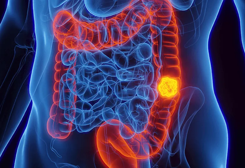 Los jóvenes enfrentan mayores tasas de cáncer colorrectal